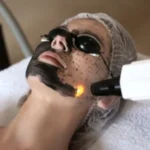 Dark Area Carbon laser