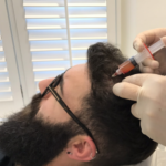 Hair PRP